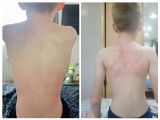 Массаж при кривошее, сколиоза. У мальчика 12 лет кривошея,сколиоз 1ст.